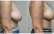 scarless_breast_reduction_before_after_16
